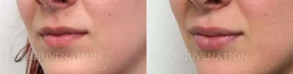 Procedure result at Eos Rejuvenation