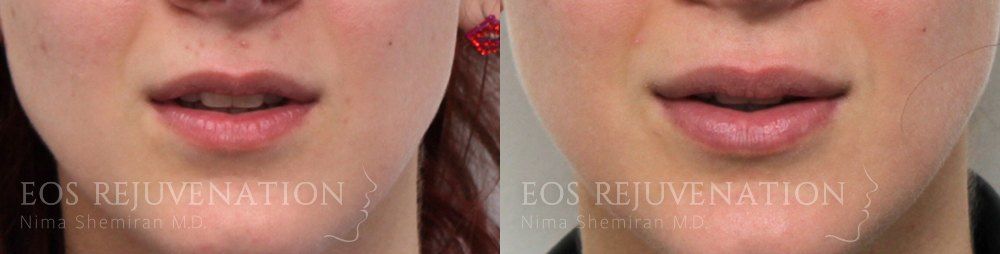 Procedure before photo