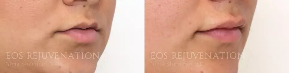 Procedure result at Eos Rejuvenation