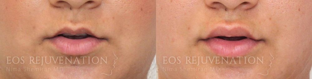 Procedure before photo