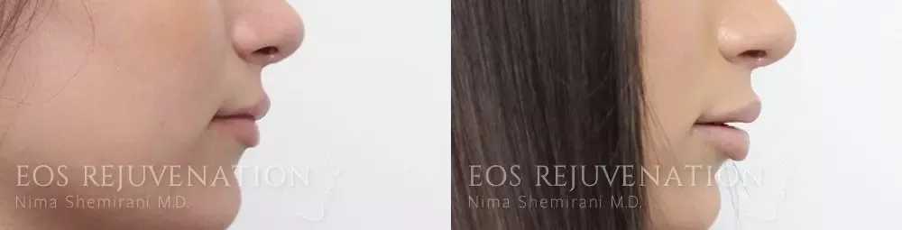 Procedure result at Eos Rejuvenation