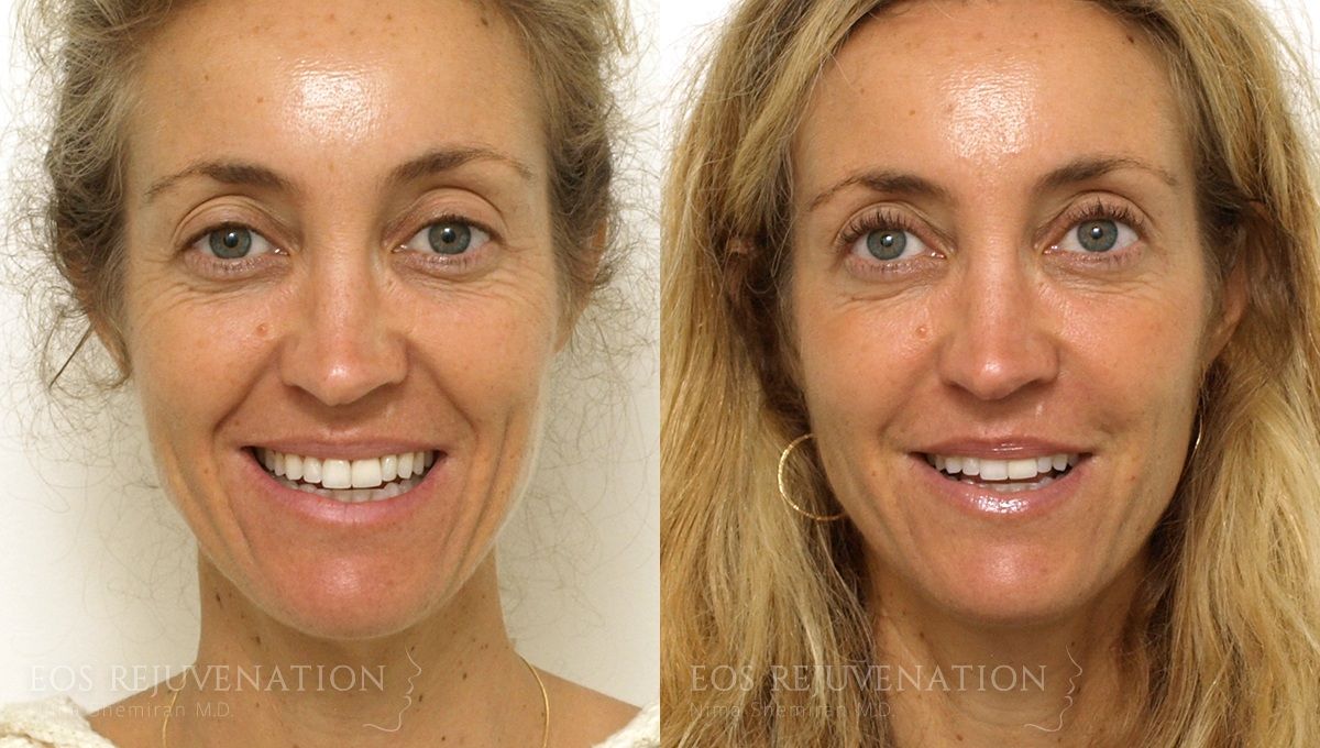 Procedure result at Eos Rejuvenation