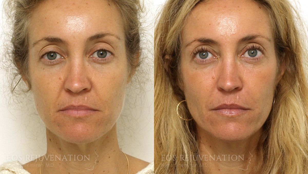 Procedure before photo