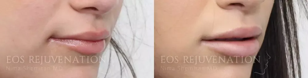 Procedure result at Eos Rejuvenation