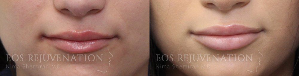 Procedure before photo