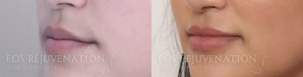 Procedure result at Eos Rejuvenation