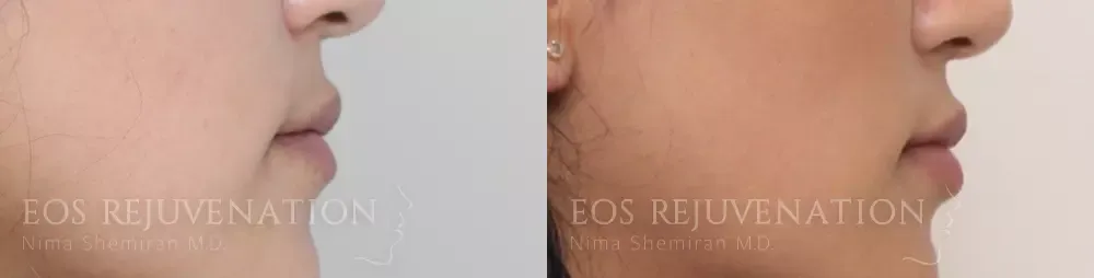 Procedure before photo