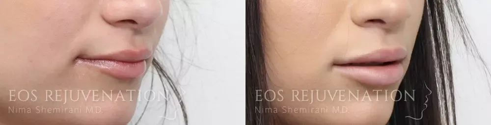 Procedure result at Eos Rejuvenation