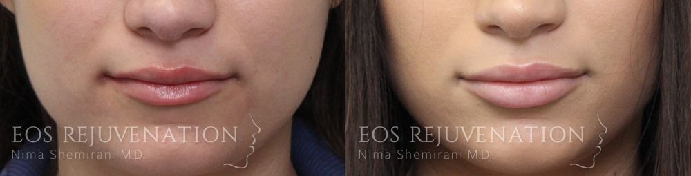 Procedure before photo