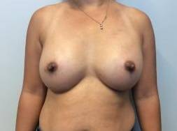 A result from The Waldorf Center for Plastic Surgery