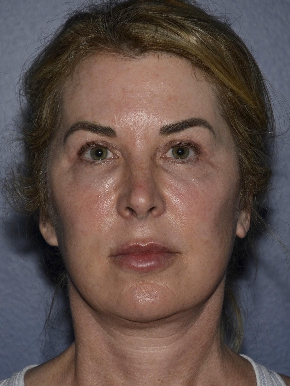A result from Amadi Aesthetics Plastic Surgery