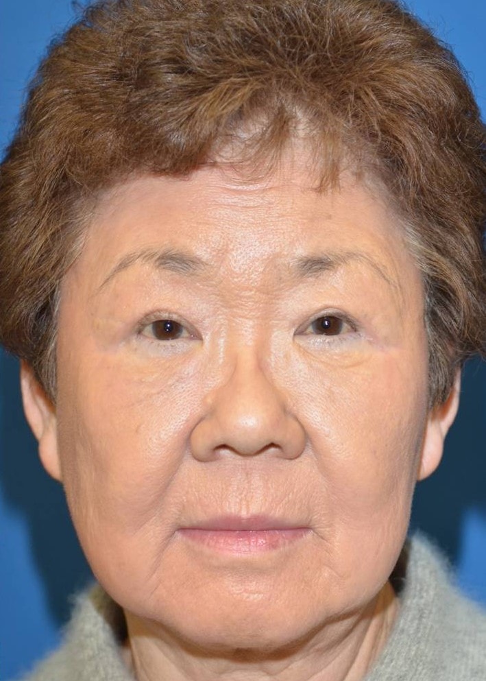 A result from Amadi Aesthetics Plastic Surgery