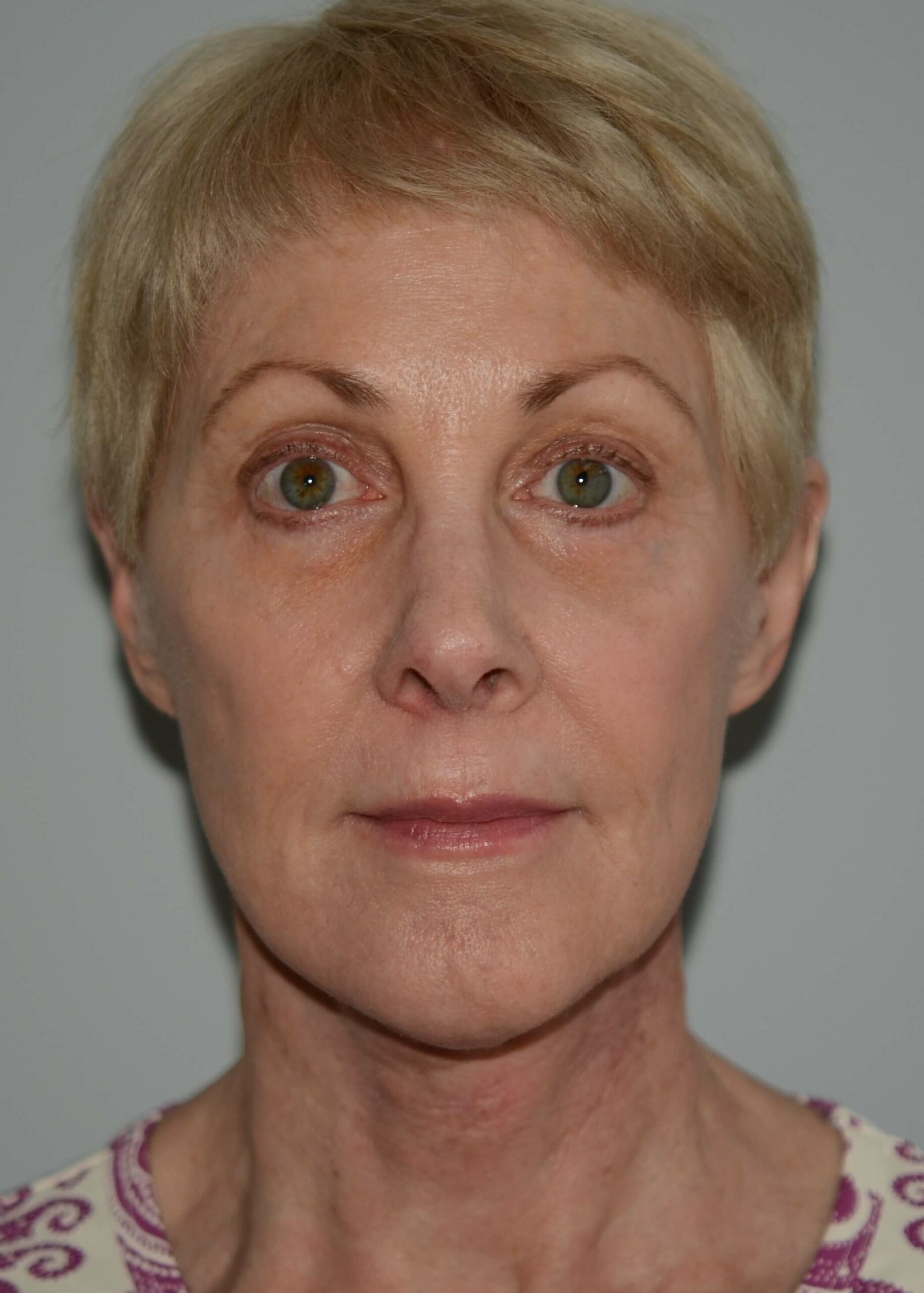 A result from Amadi Aesthetics Plastic Surgery