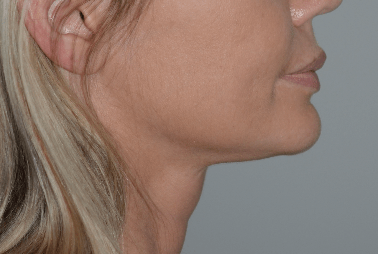 A result from Amadi Aesthetics Plastic Surgery