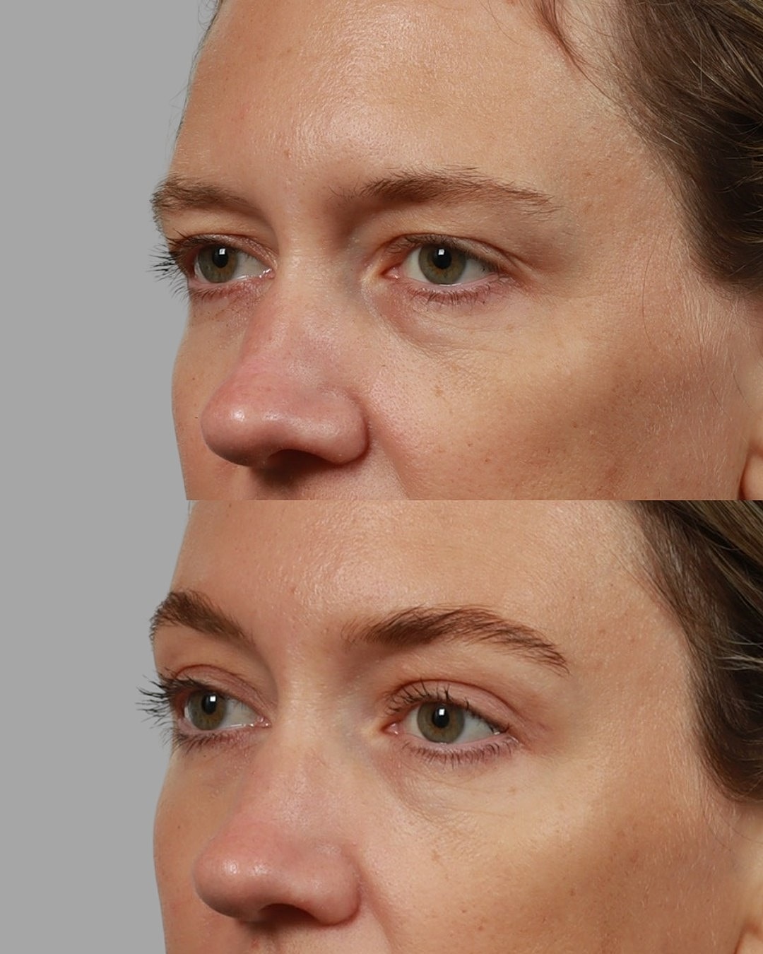 A result from Locketz Facial Plastic Surgery