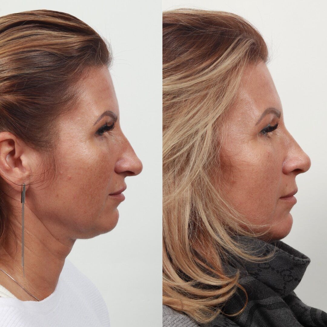 A result from Locketz Facial Plastic Surgery