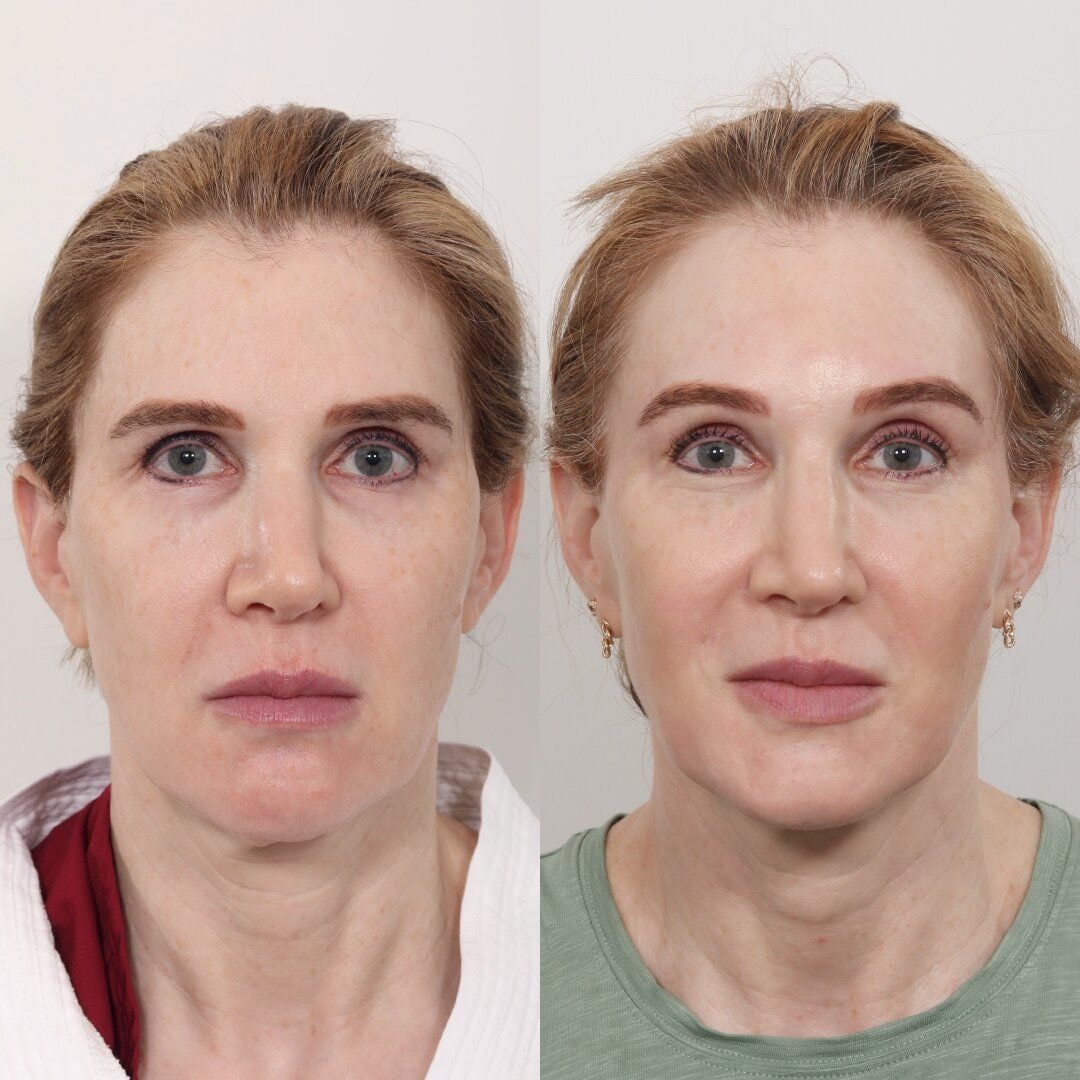 A result from Locketz Facial Plastic Surgery