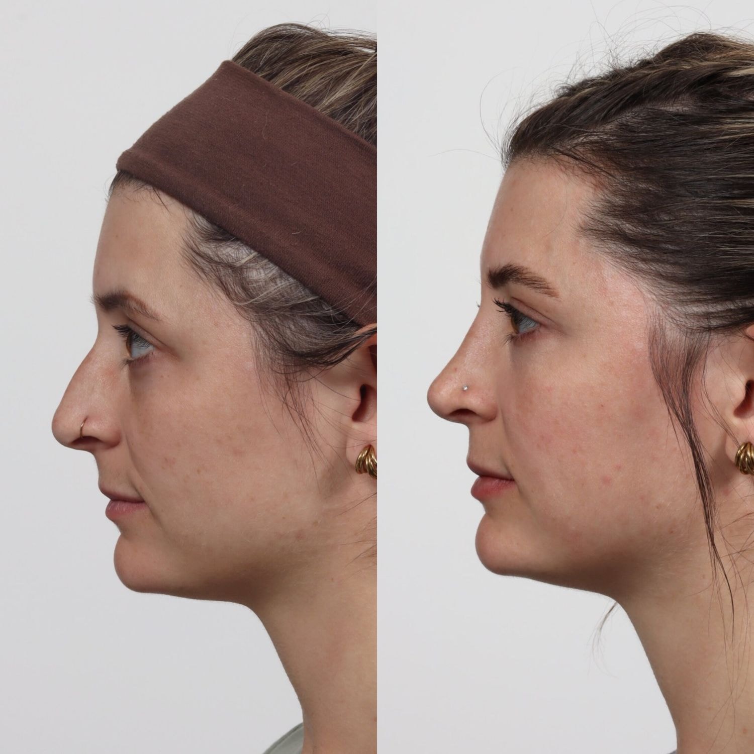 A result from Locketz Facial Plastic Surgery