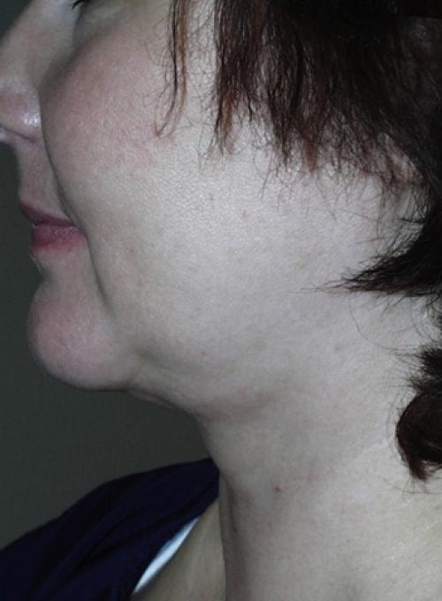 A result from Cosmetic Surgery & Dermatology of Issaquah