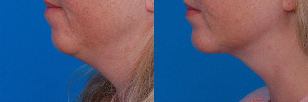 A result from Batniji Facial Plastic Surgery