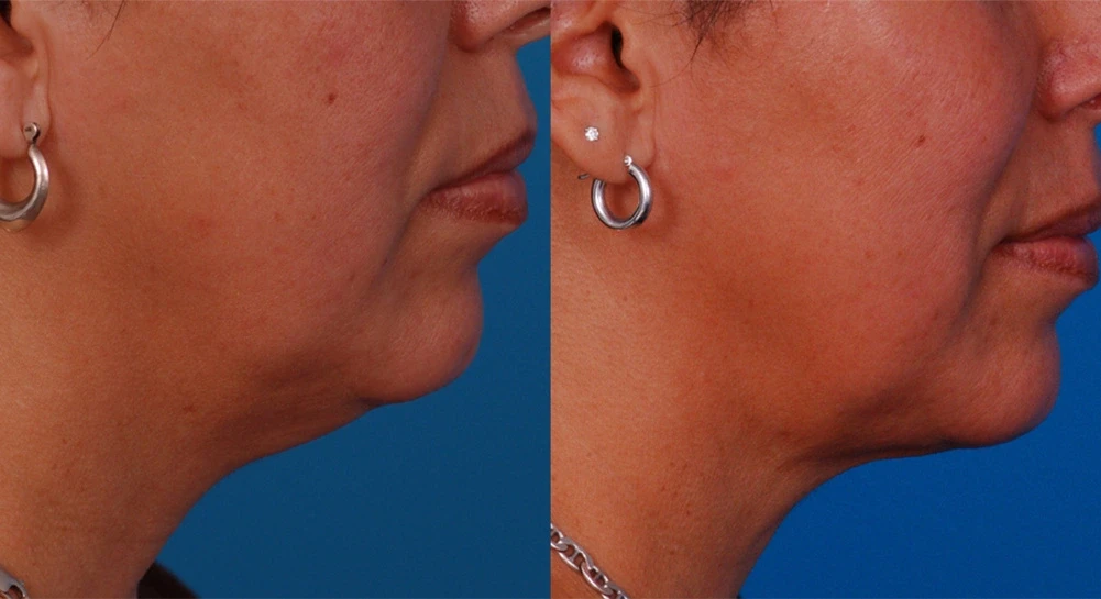 A result from Batniji Facial Plastic Surgery