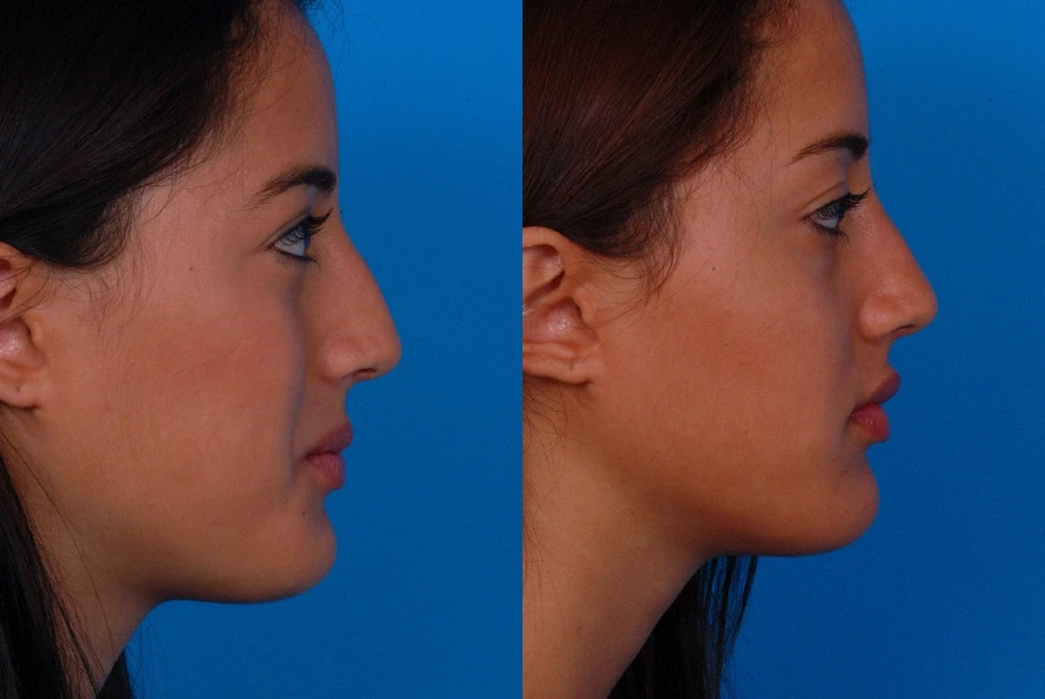 A result from Batniji Facial Plastic Surgery