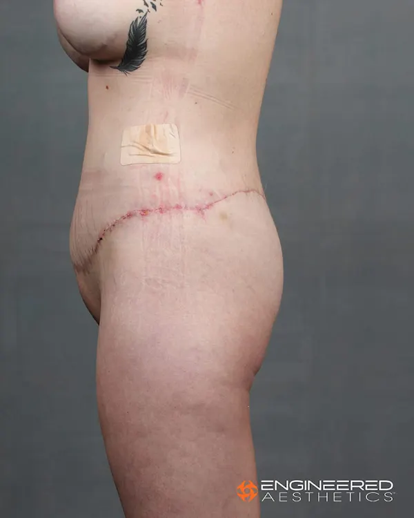 Procedure result at Engineered Aesthetics
