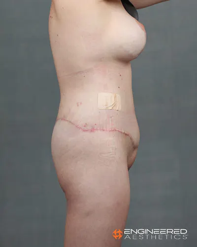 Procedure result at Engineered Aesthetics