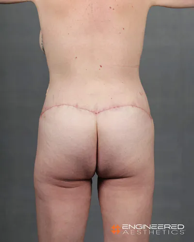 Procedure before photo