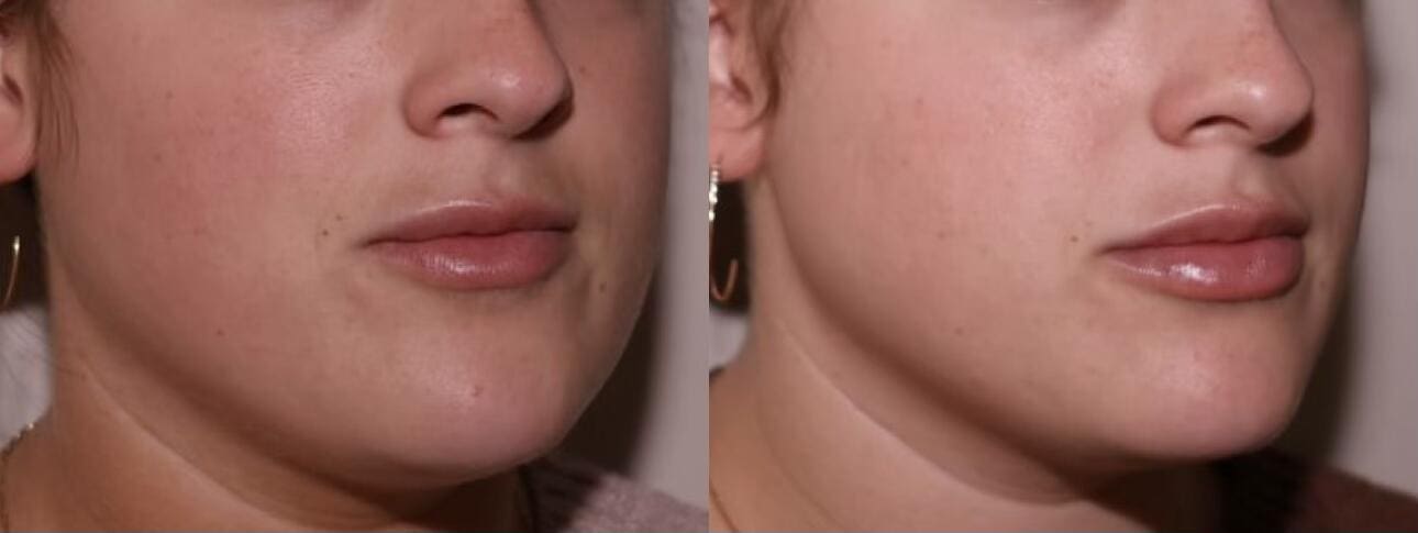 A result from SKN at Franks Dermatology