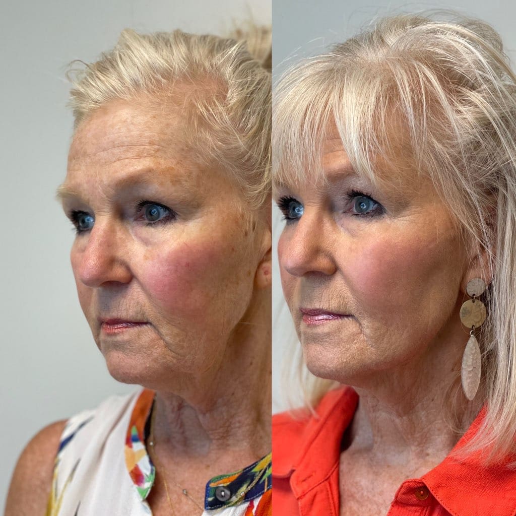 A result from SKN at Franks Dermatology