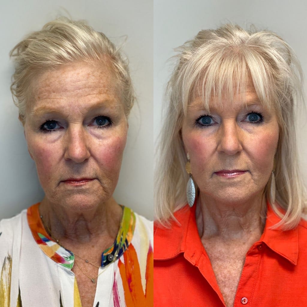 A result from SKN at Franks Dermatology
