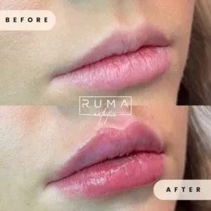 A result from RUMA Medical