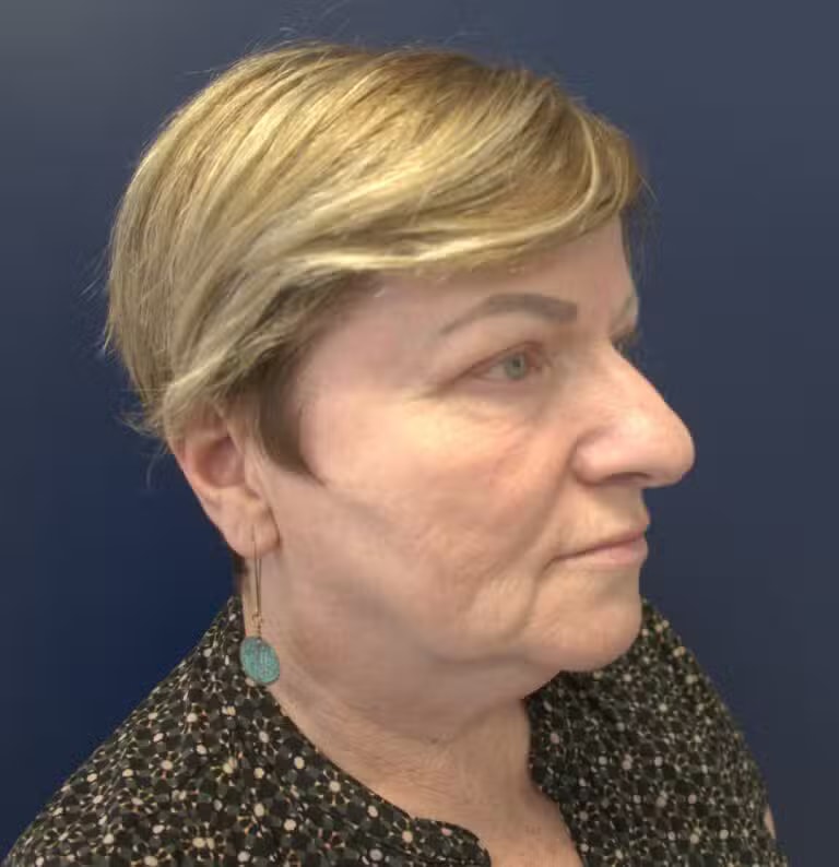 A result from Advanced Plastic Surgery of North Shore (Mahira Tanovic, MD)