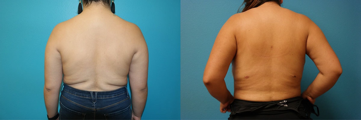 A result from Dr. Candis Lovelace, MD, FACS