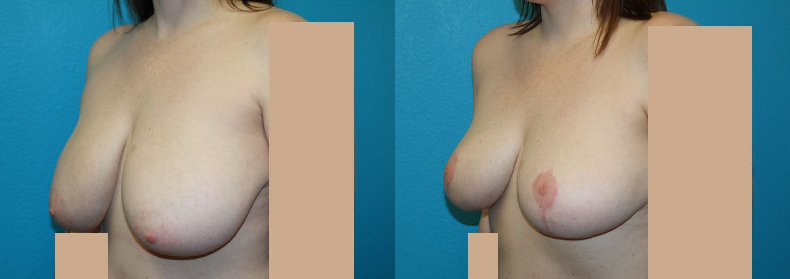 A result from Dr. Candis Lovelace, MD, FACS