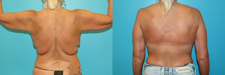 A result from Dr. Candis Lovelace, MD, FACS