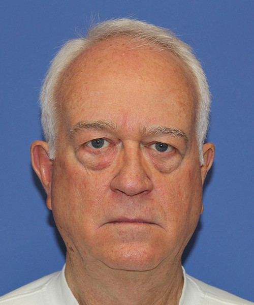 Blepharoplasty before photo