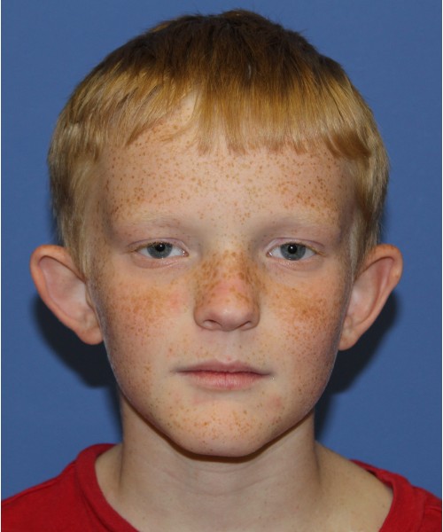 Otoplasty before photo