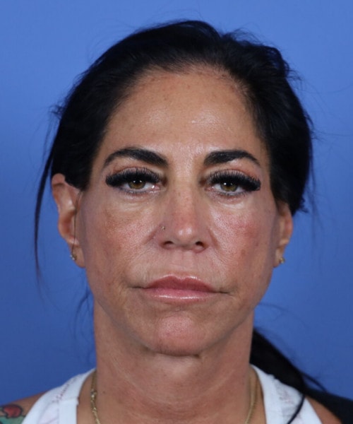 A result from Bitner Facial Plastic Surgery of Utah