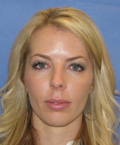 Blepharoplasty before photo