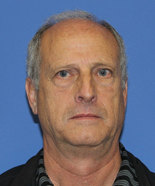 Blepharoplasty before photo
