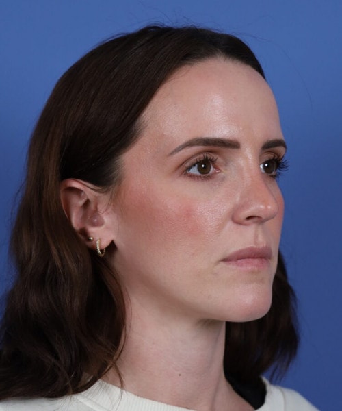 A result from Bitner Facial Plastic Surgery of Utah