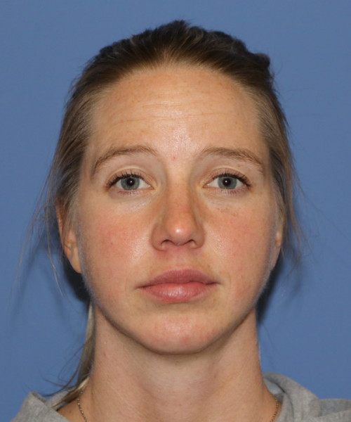 A result from Bitner Facial Plastic Surgery of Utah