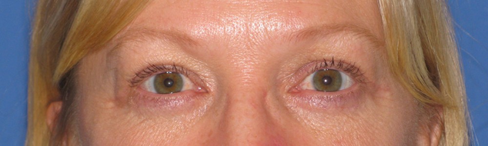 A result from Bitner Facial Plastic Surgery of Utah