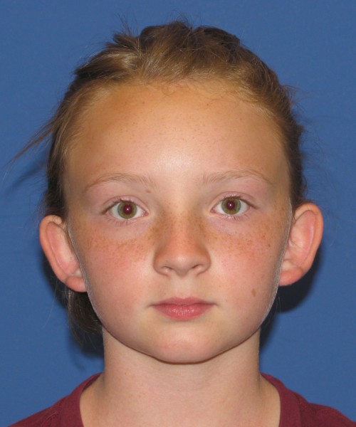 Otoplasty before photo