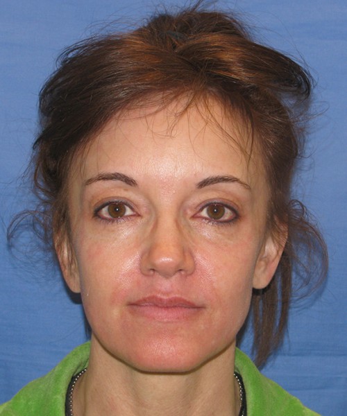 Blepharoplasty before photo