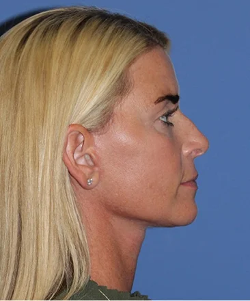A result from Bitner Facial Plastic Surgery of Utah