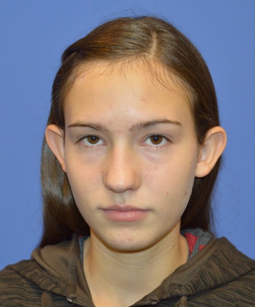 Otoplasty before photo