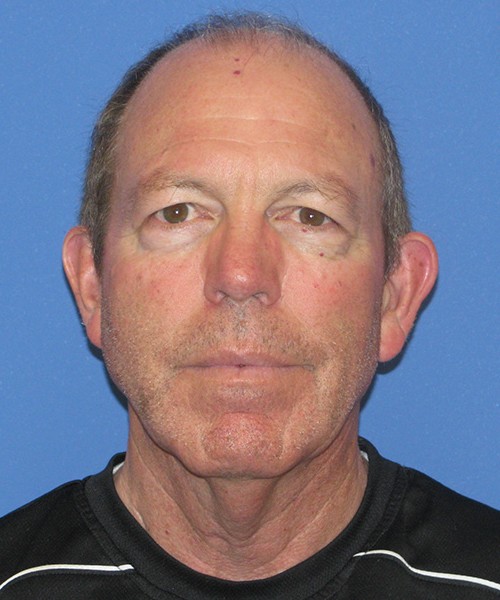 Blepharoplasty before photo